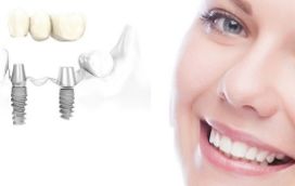 Vì sao nên chọn cấy ghép Implant