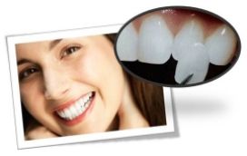 Mặt dán sứ Veneers