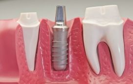 Thời gian cấy ghép Implant