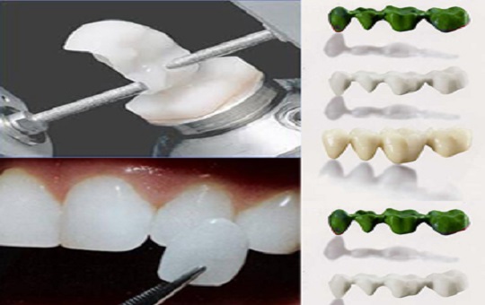  Cầu răng- Kỹ thuật CEREC