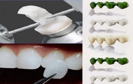  Cầu răng- Kỹ thuật CEREC