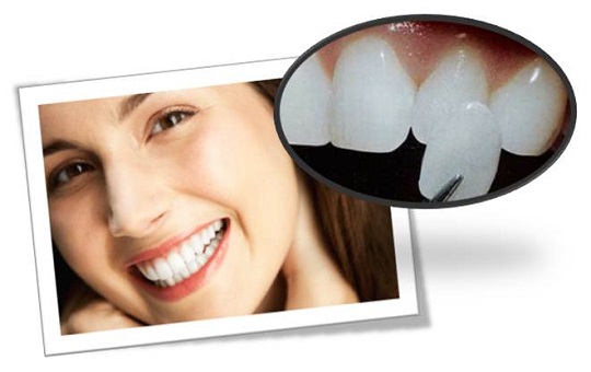 Mặt dán sứ Veneers